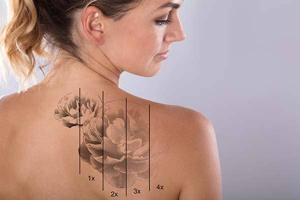 Eliminación de tatuajes: ¿En qué consiste?. Resultados