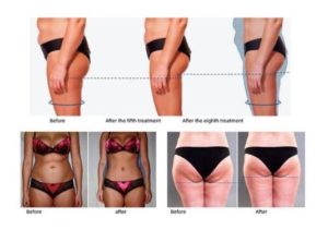 Remodelación corporal antes y después