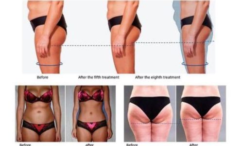 Remodelación corporal antes y después